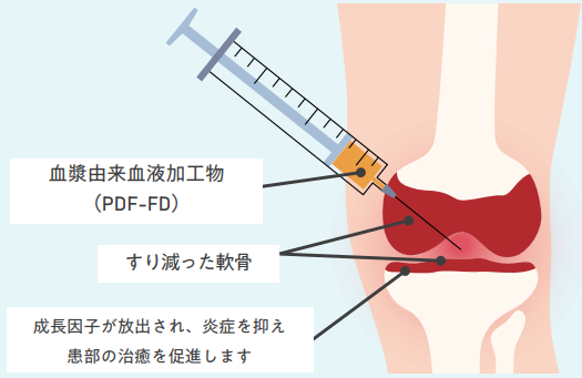 PDF-FD療法とは